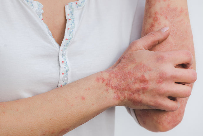 Explorando a eficácia do CBD no tratamento de problemas de pele como acne, eczema e psoríase